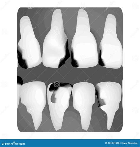 Dental Caries X Ray Of Tooth Decay Caries Infographics Vector