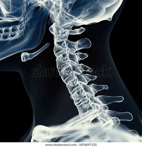 3,020 Xray Cervical Images, Stock Photos & Vectors | Shutterstock