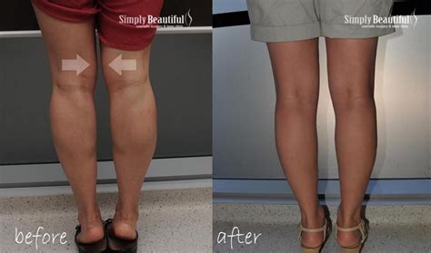 Fat Dissolving Injections Dr Peter Kim Cosmetic Laser Clinic