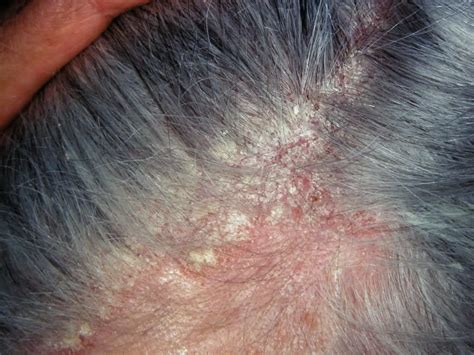 Seborrheic Dermatitis Scalp