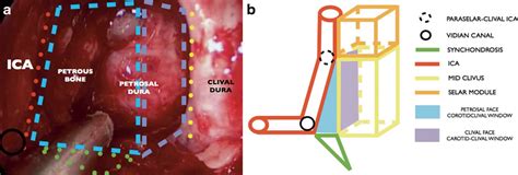 Full Endoscopic Endonasal Expanded Approach To The Petroclival Region