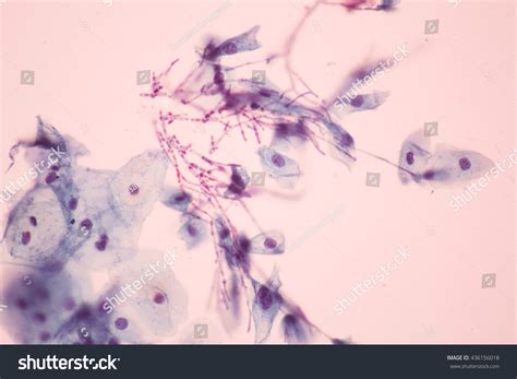 Candida Albicans Infecion Pap Smearview Microscopicmedical Stock Photo