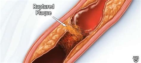 How to reduce your risk for coronary artery disease