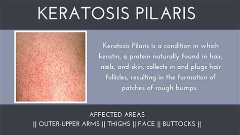 Keratosis Pilaris – Medical Dermatology Condition