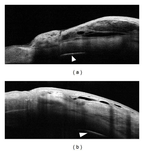 Filtering Bleb Morphology After Biodegradable Collagen Matrix