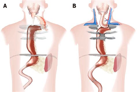 Figure 3 From Managing Esophagocutaneous Fistula After Secondary