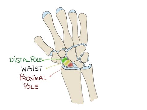 Scaphoid Fractures How To Not Miss Them Pro Doctor