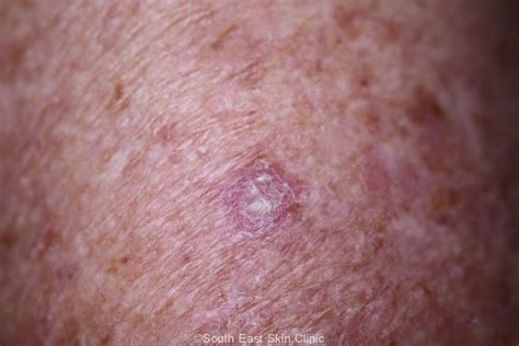 Scc Squamous Cell Carcinoma South East Skin Clinic