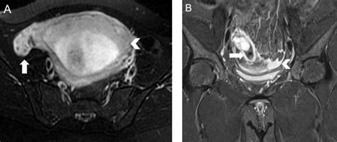 Magnetic Resonance Imaging In Tubal And Non Tubal Ectopic Pregnancy