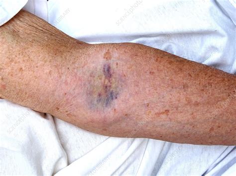 Blood Draw Hematoma