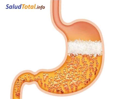 ¿qué Es La Hipoclorhidria Causas Síntomas Diagnóstico Y Tratamiento