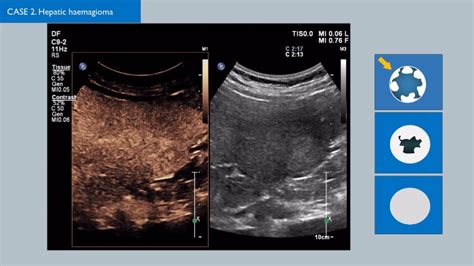 Ultrasonidos Con Contraste Philips Healthcare