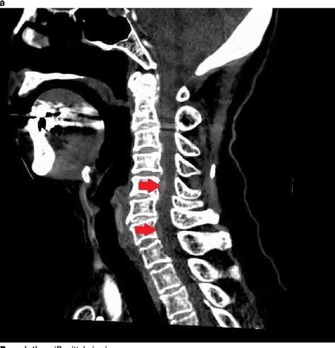 Figure From Acute Spontaneous Spinal Subdural Hematoma In The