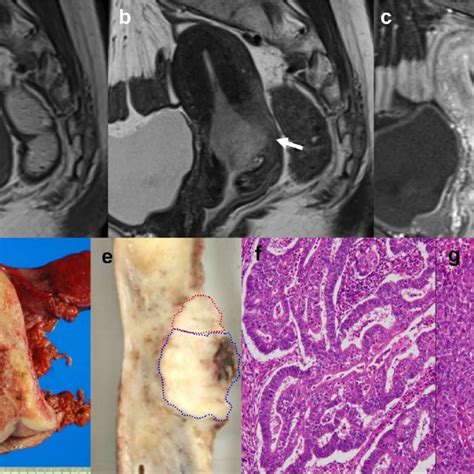 A Case Of A 46 Year Old Woman With Dedifferentiated Endometrial Download Scientific Diagram