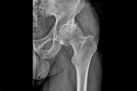 Osteonecrosis Of The Hip