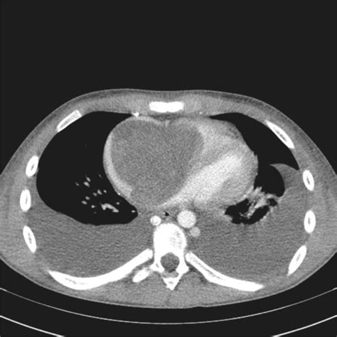 Ct Of Thorax With Iv Contrast Axial Plane Download Scientific Diagram