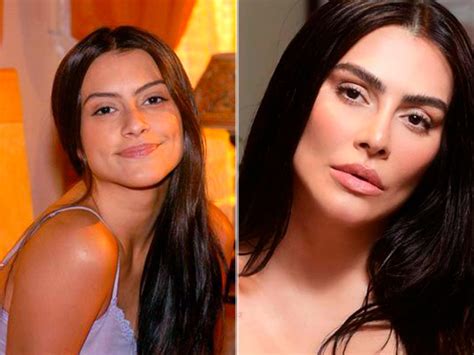 Rinoplastia Famosos Saiba Quais Celebridades Fizeram Dream