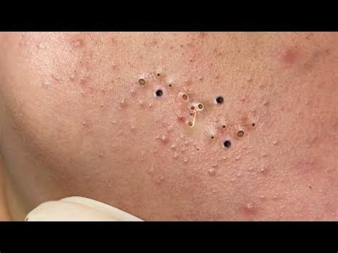 Youtube Blackheads On