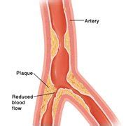 Causes of Angina Pectoris And Modifiable Risk Factors