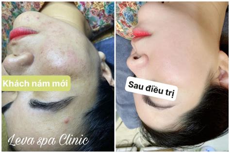 Top 6 Spa trị nám hiệu quả nhất TP Thủ Đức TP HCM toplist vn