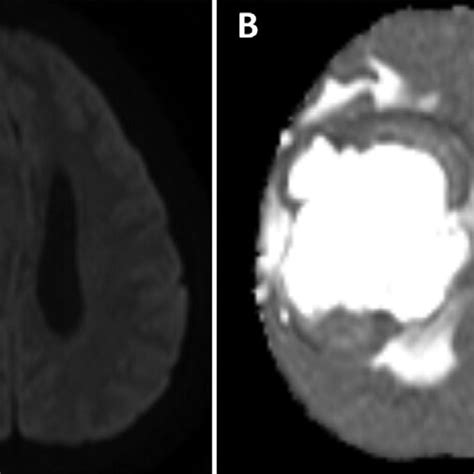 A Diffusion Weighted Image And B Apparent Diffusion Coefficient