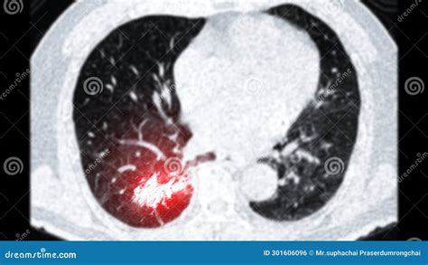 Ct Scan Of Chest Or Lung Axial Viewshowing Lung Cancer Lung Cancer