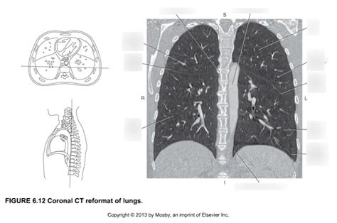 Coronal Ct Reformat Of Lungs Diagram Quizlet