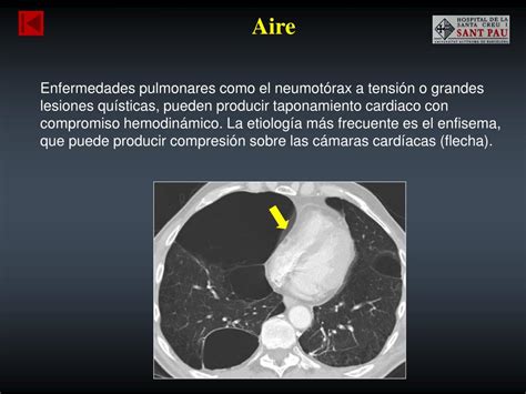 PPT Taponamiento cardíaco Causas y hallazgos radiológicos PowerPoint