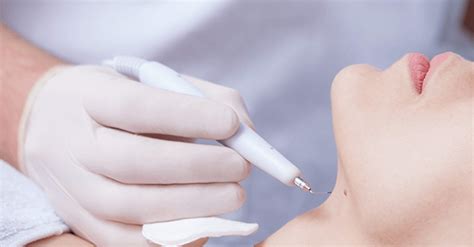 How Do Dermatologists Remove Skin Tags? (2023) – Skintify