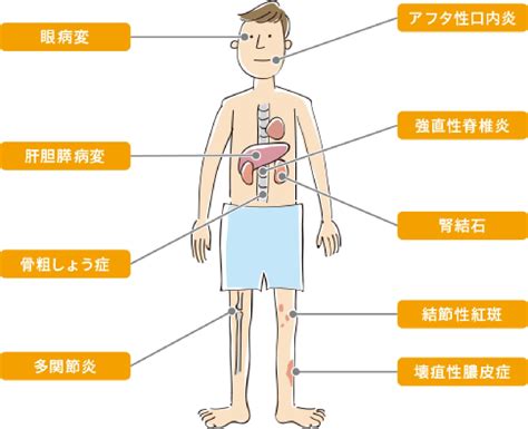 クローン病になるとどうなるの？ クローン病の基礎知識 クローン病 Ibd Life