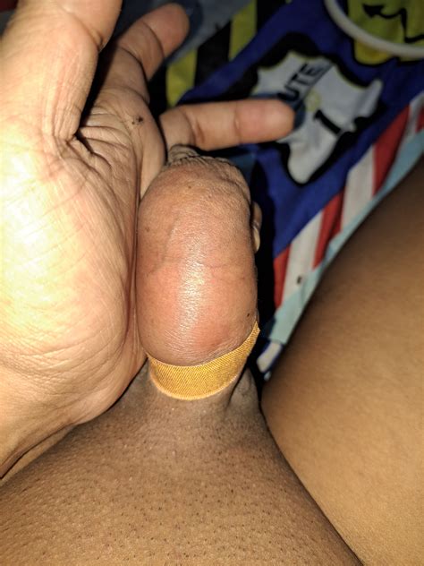 Myanmar Gay Saline Injection Photo 17 BoyFriendTV