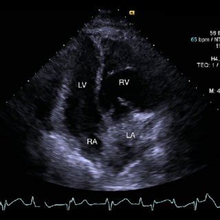 Chest X Ray Of The Patient Showing Bilateral Fluffy Infiltrates