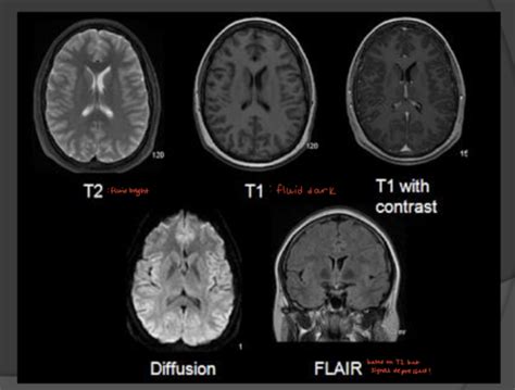 Mri Flashcards Quizlet