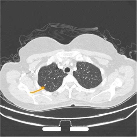 Ct Scan Of The Chest Showing The Small Pulmonary Nodule In The Right Download Scientific