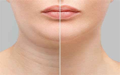 Say Goodbye To Double Chin Kybella The Game Changer