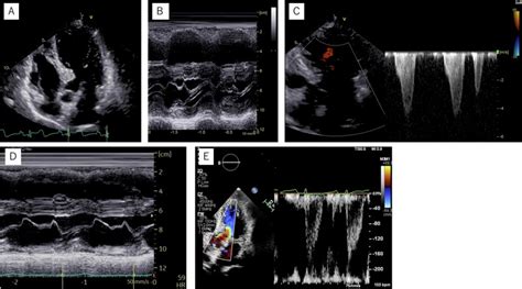 A Case Of Syncope After Exertion Due To Sigmoid Septum Evaluated By Exercise Stress