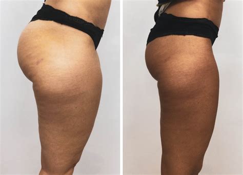 Velashape III Clínica Rigo