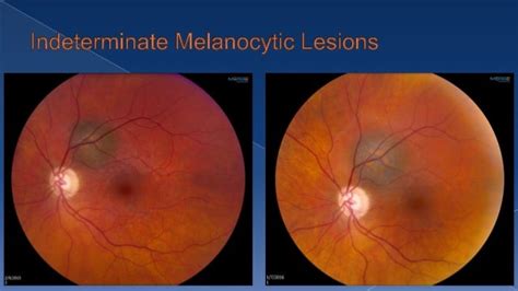 Ocular Melanoma Basics