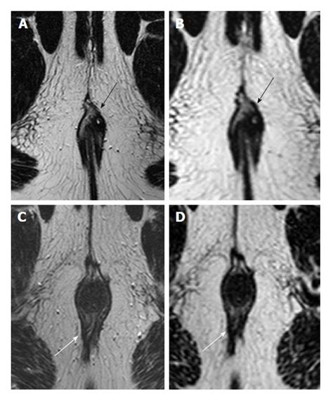 Perianal Fistula Mri