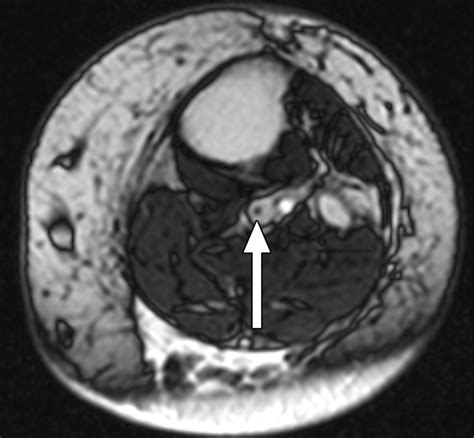 Utility Of Balanced Steady State Free Precession Mr Venography In The