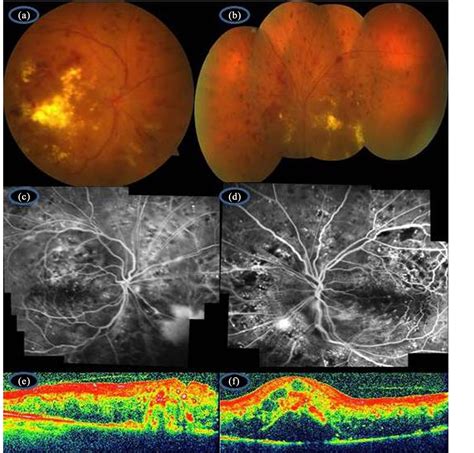 Simultaneous Intravitreal Ranibizumab And Dexamethasone Implant Administration At The Same