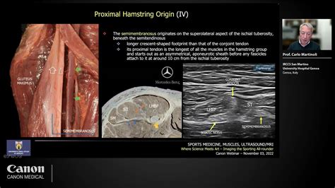 Ultrasound Of Hamstring Injuries What Should We Know And Look At Youtube