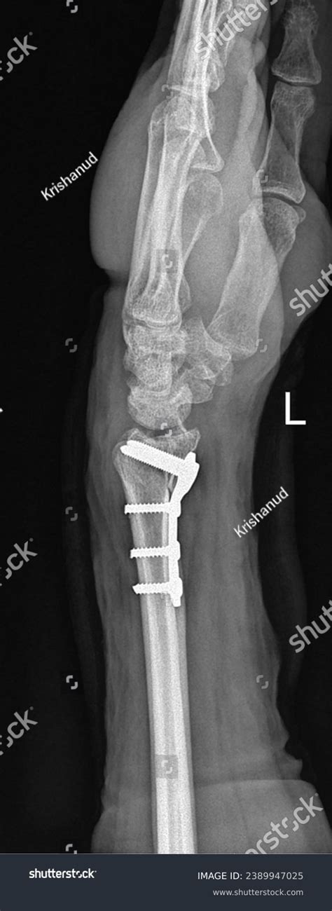 Surgical Fixation Distal Forearm Fracture Radiographic Stock Photo ...