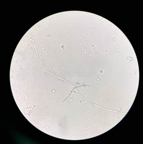 Budding Yeast Cells With Pseudohyphae In Urine Sample Stock Image