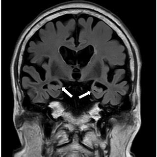 Coronal Fluid Attenuation Inversion Recovery Magnetic Resonance Imaging