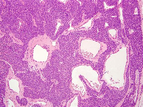 Pathology Outlines Glomus Tumor