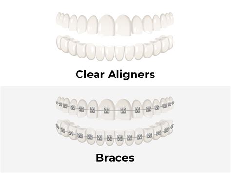 Clear Braces Vs Clear Aligners What Is The Difference