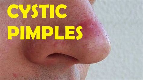 How To Get Rid Of Cystic Pimples On Nose Youtube