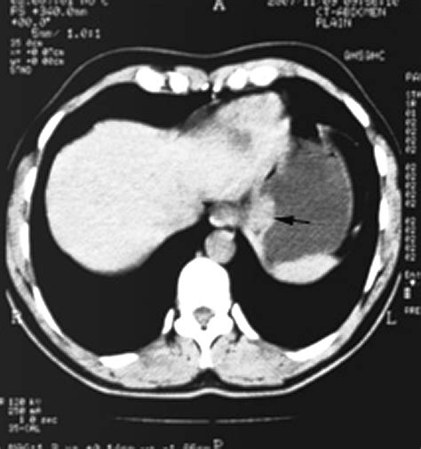 A Gastric Submucosal Mass Gut