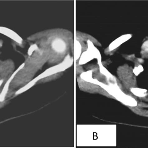 Pdf High Riding Innominate Artery An Unusual Pulsatile Pretracheal